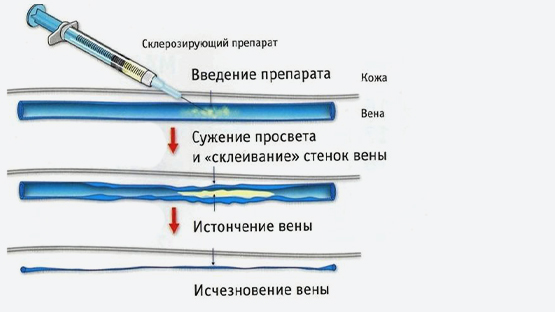 Склеротерапия вен в Барнауле